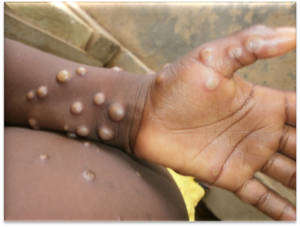 Wanaofanya mapenzi ya jinsia moja hatarini zaidi virusi vya MPOX